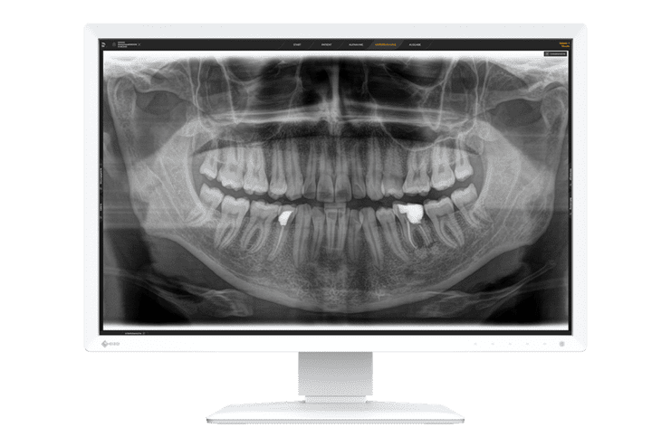 Röntgenaufnahme eines Unterkiefers mit sichtbaren Zähnen und zwei fehlenden Zähnen im Frontbereich auf einem Monitor.