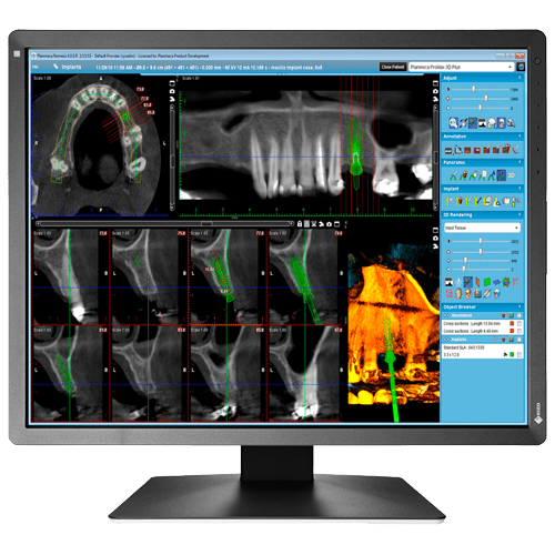 Bildschirm mit medizinischer Bildgebung, zeigt 3D-Dentalscan und Analysewerkzeuge in einer Software-Oberfläche.